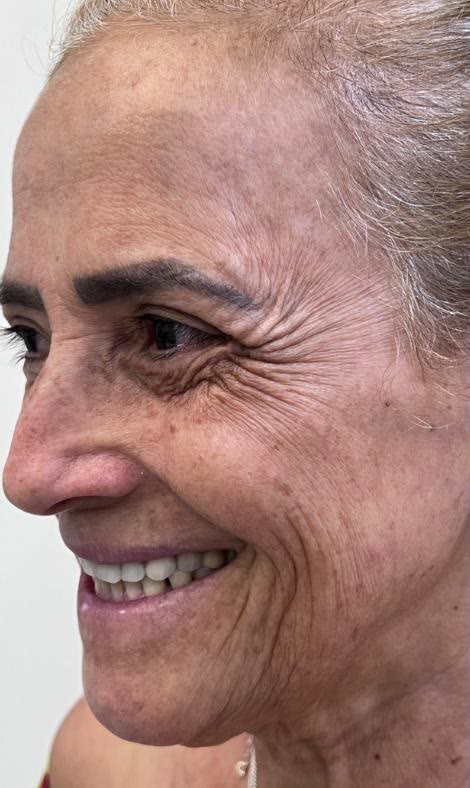 Antes do tratamento facial em outra paciente