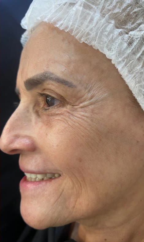 Depois do tratamento facial na mesma paciente