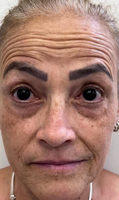 Antes do tratamento facial em uma paciente madura