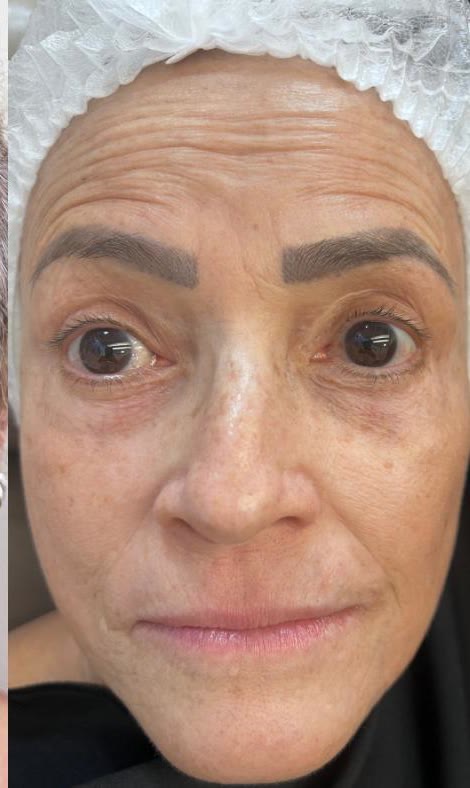 Depois do tratamento facial na mesma paciente