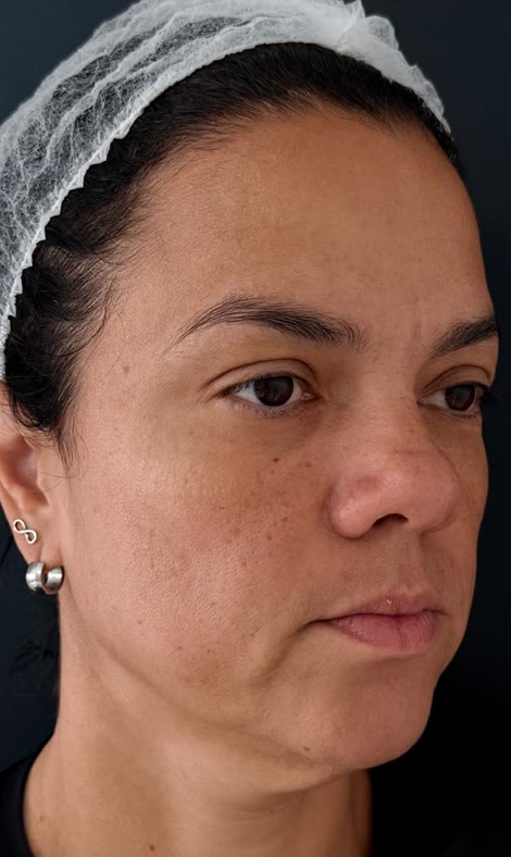 Antes do tratamento facial em outra paciente