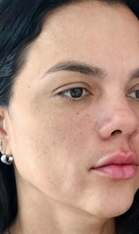 Depois do tratamento facial na mesma paciente