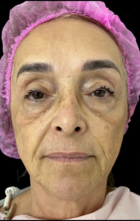 Antes do Protocolo NS Beauty, vista frontal da paciente