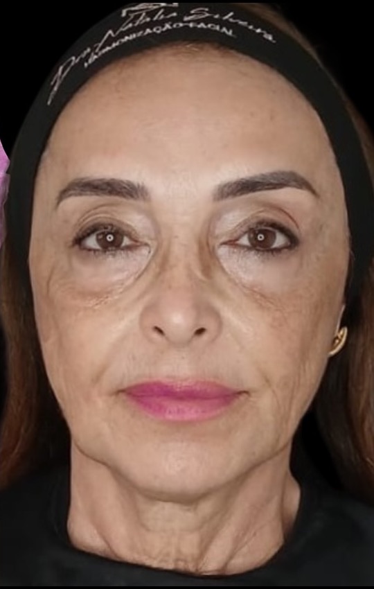 Depois do Protocolo NS Beauty, vista frontal da mesma paciente