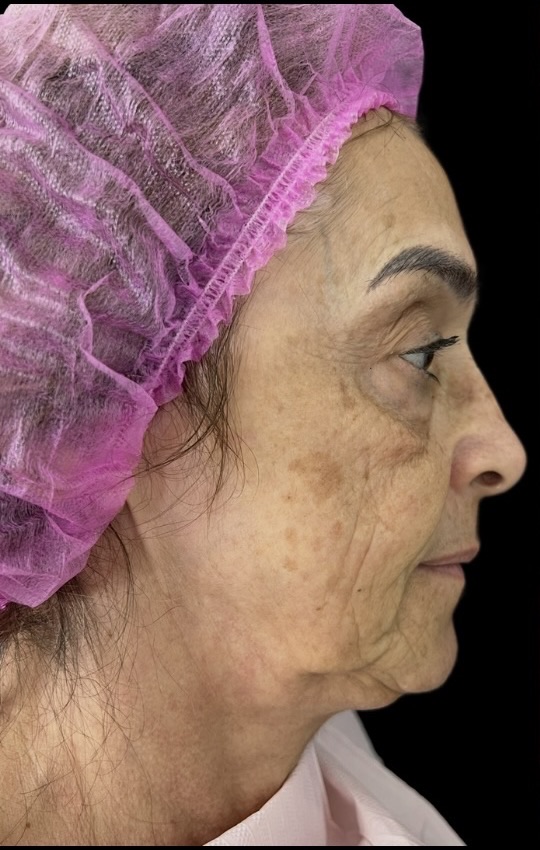 Antes do Protocolo NS Beauty, vista de perfil da paciente