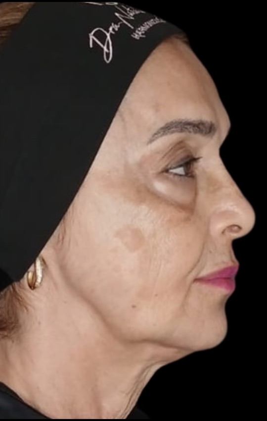 Depois do Protocolo NS Beauty, vista de perfil da mesma paciente