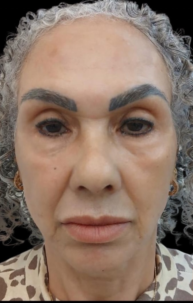 Antes do planejamento facial individualizado em uma paciente