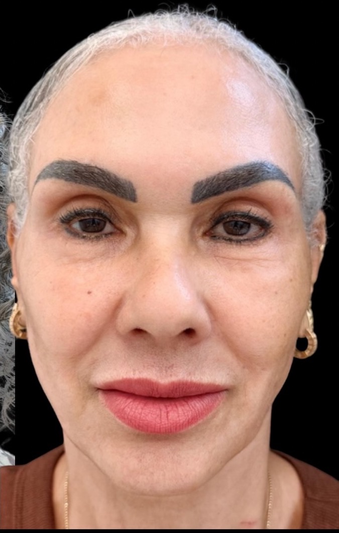 Depois do planejamento facial individualizado na mesma paciente