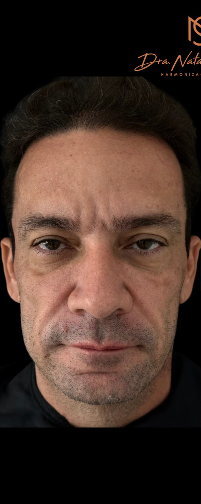 Antes do Protocolo NS Beauty para homens