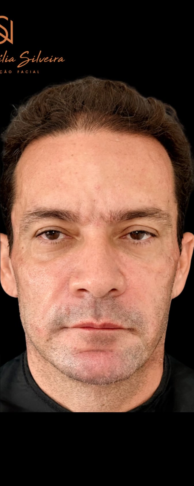 Depois do Protocolo NS Beauty para homens