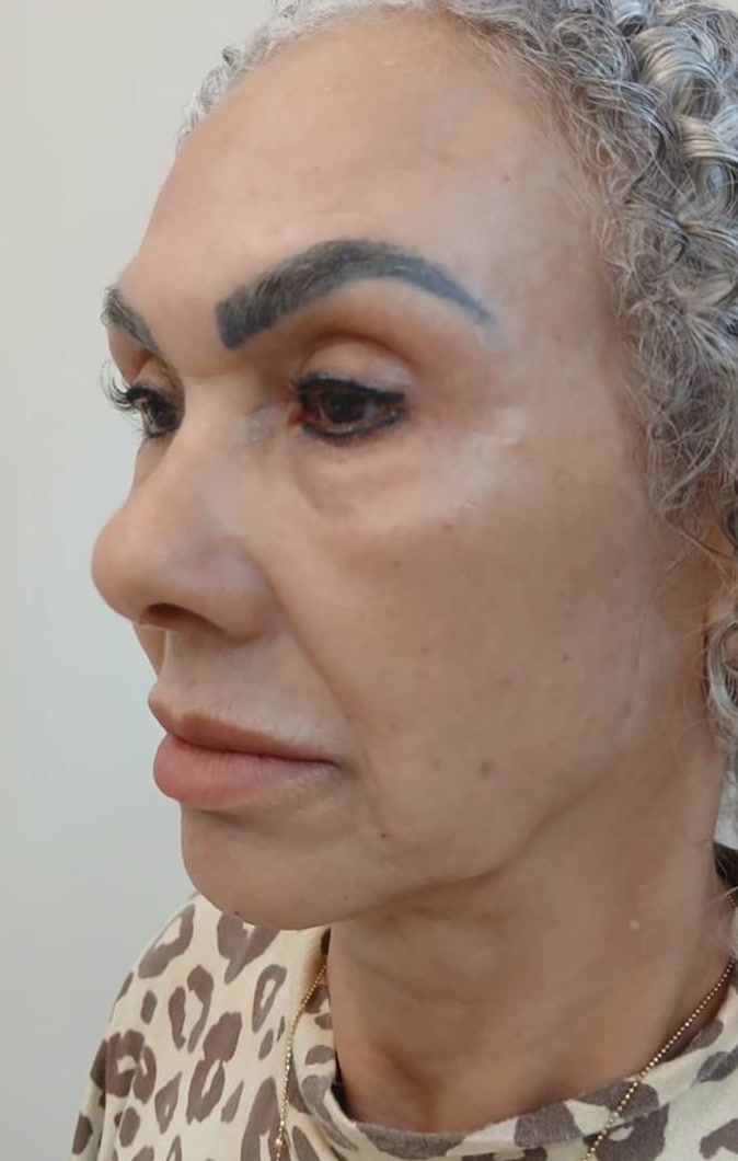 Antes do planejamento facial, vista lateral da paciente