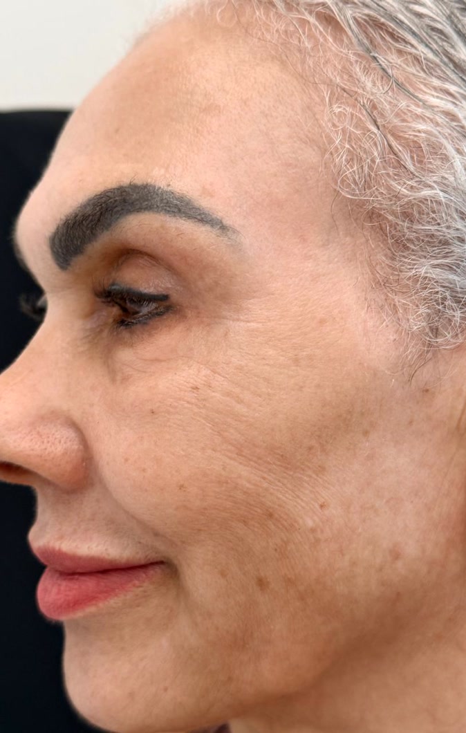 Depois do planejamento facial, vista lateral da paciente