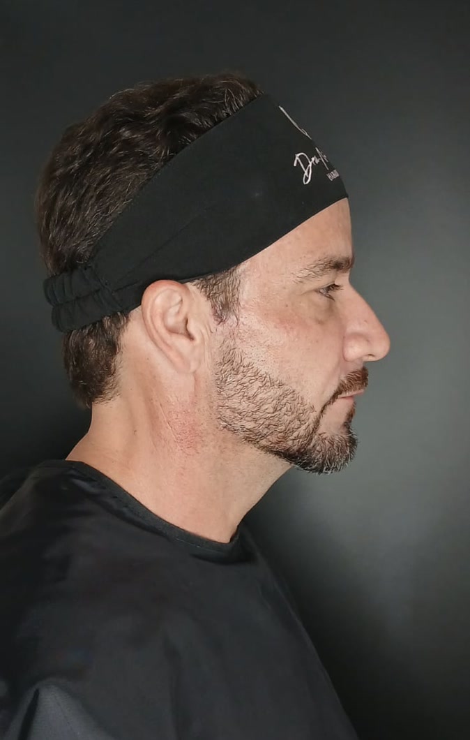 Antes do rejuvenescimento masculino, vista de perfil