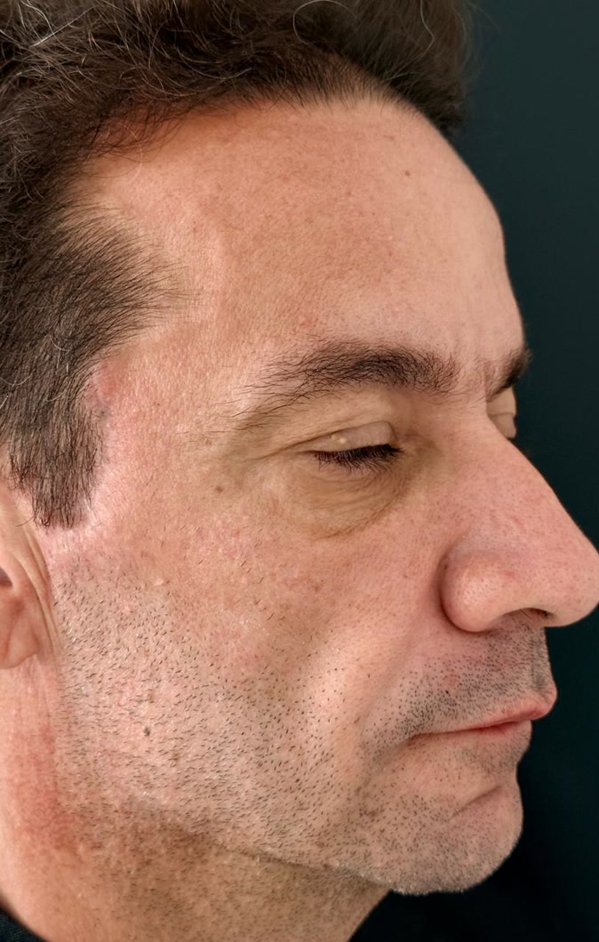 Depois do rejuvenescimento masculino, vista de perfil