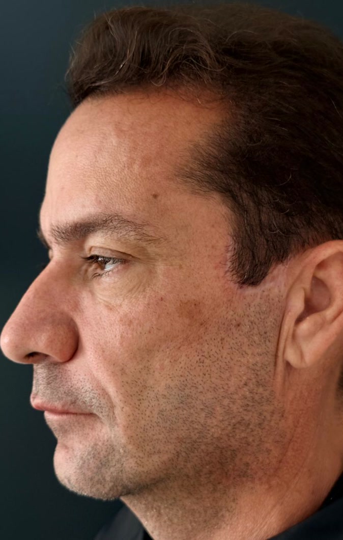 Depois do rejuvenescimento masculino, vista do outro perfil