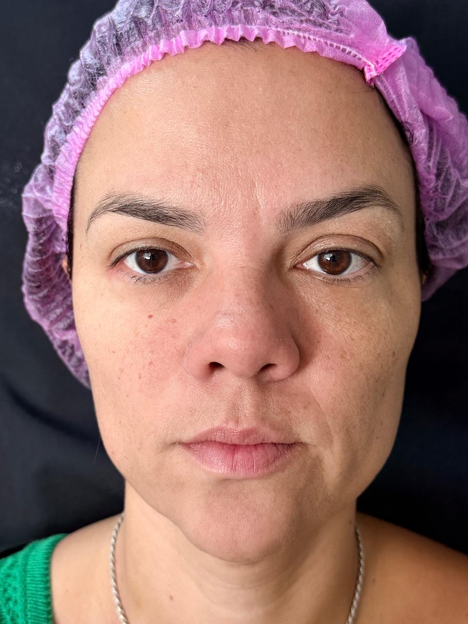 Antes do preenchimento labial, vista frontal da paciente