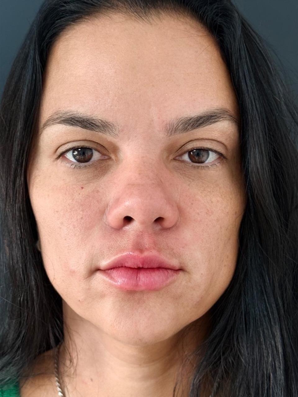 Depois do preenchimento labial, vista frontal da mesma paciente