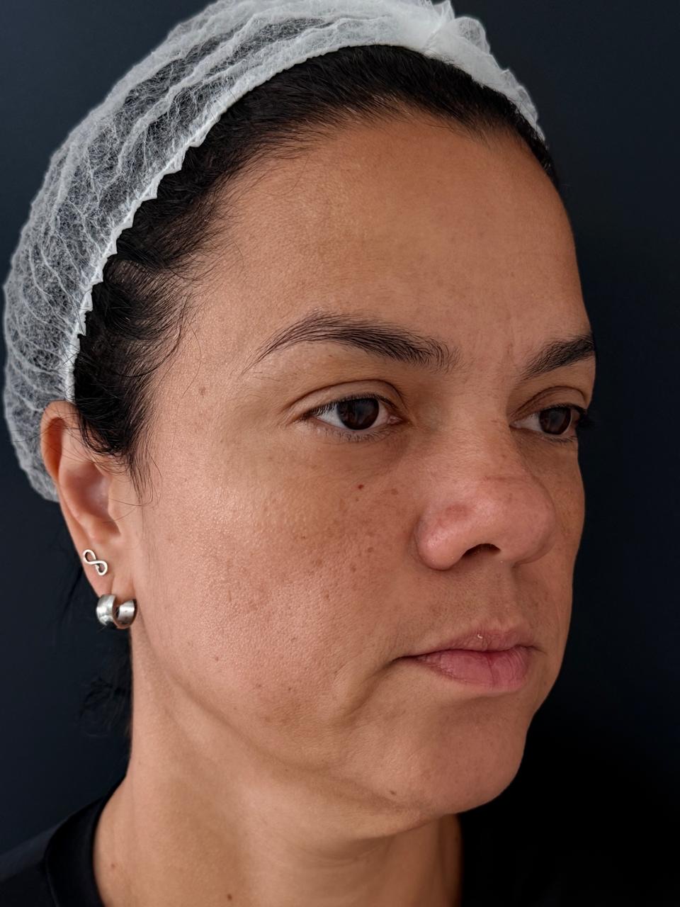 Antes do preenchimento labial, vista lateral da paciente