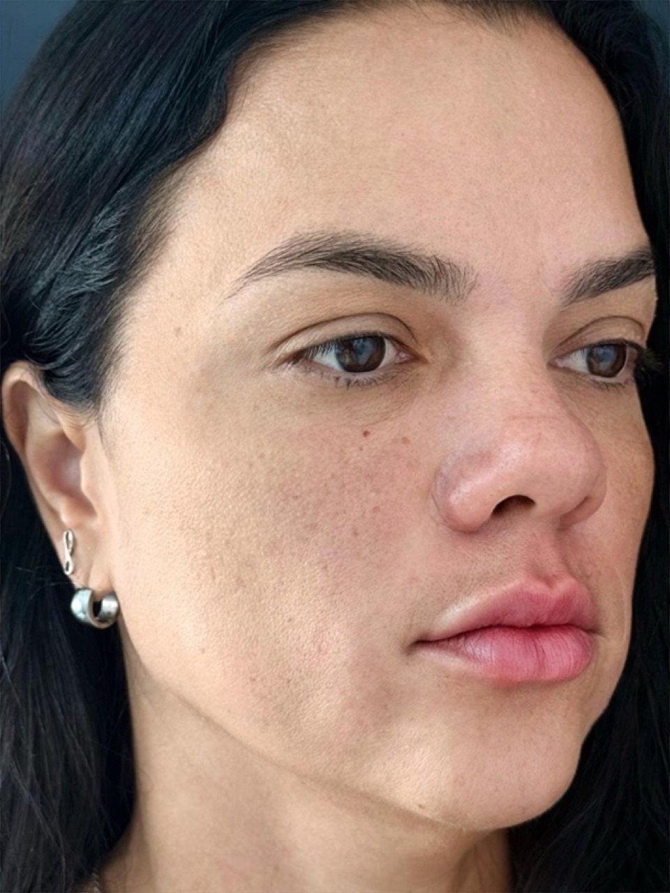 Depois do preenchimento labial, vista lateral da mesma paciente